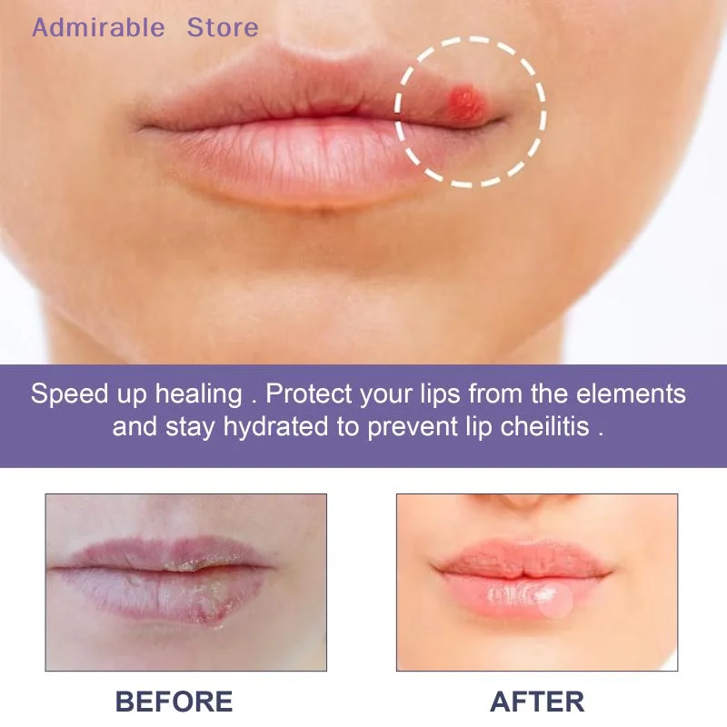 wHydrocolloid Cold Sore Patch 36pcs Lip Blister Care Stickers Invisible Barrier Fast Relief for Outdoor Activities and Work