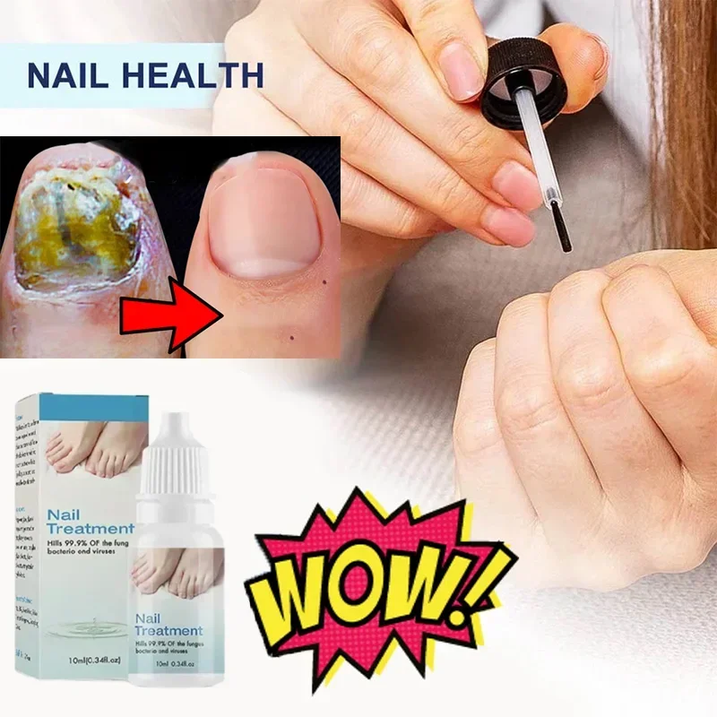 Nail Fungal Treatment Serum Onychomycosis Paronychia Anti Infection Toe Fungus Hand Foot Removal Repair Gel Care Beauty Health