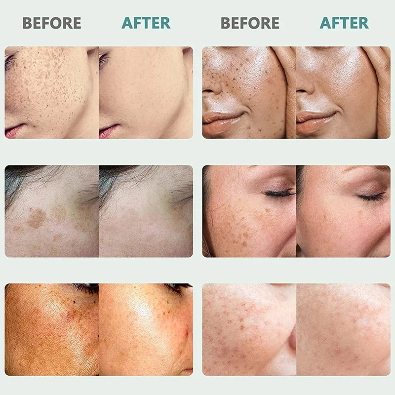 Crema eficaz para pecas, ilumina rápidamente la cara, elimina el Melasma, manchas oscuras, desvanece la melanina, blanquea, antipigmentación, mejora el cuidado del polvo