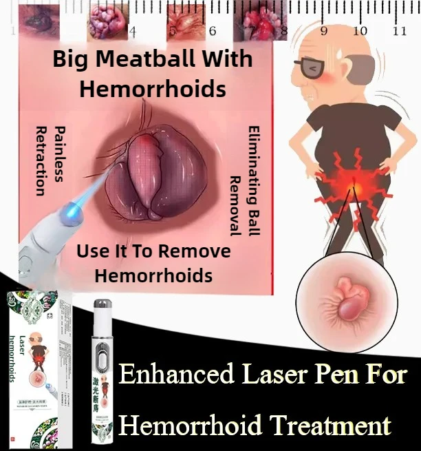 Verbesserte Laser-Stift-Hämorrhoiden-Behandlung. Die Hämorrhoiden beseitigt werden, einschließlich innerer und externer Hämorrhoiden