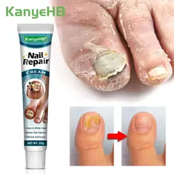 1pcs Nail Fungus Removal Cream Onychomycosis Toes Nail Antifungal Cream Nail Fall Off Discoloration Foot Psoriasis Cream G048