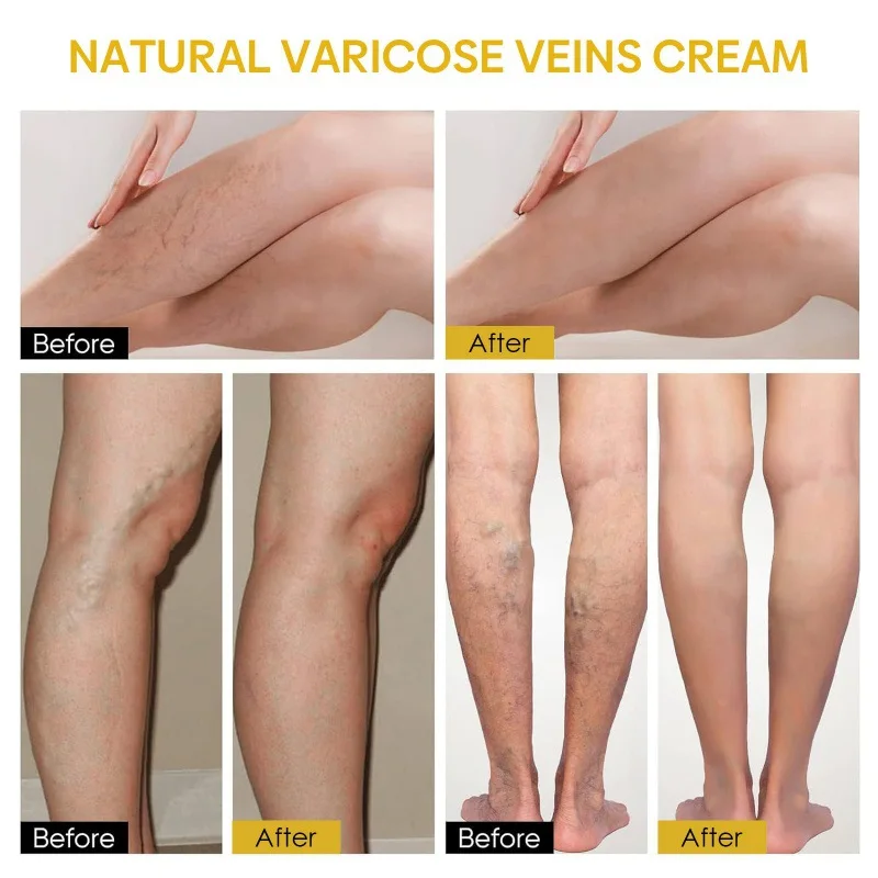 Bee Venom Vein Repair Cream To Relieve Leg Soreness and Swelling and Smooth Bulging Veins