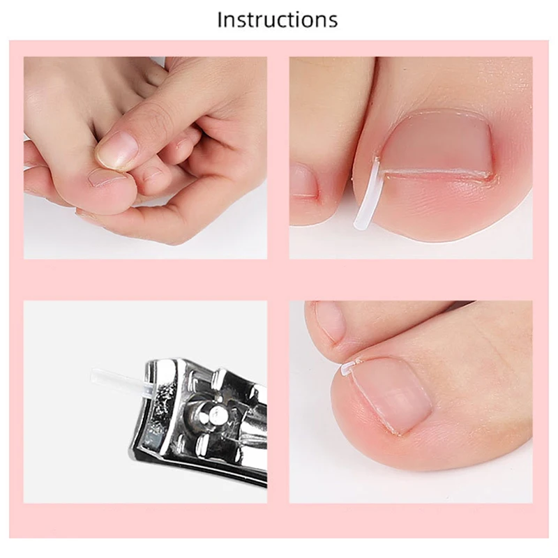 10Pcs Ingrown Toenail Correction Tool Ingrown Toe Nail Treatment Elastic Patch Sticker Straightening Clip Brace Pedicure Tool