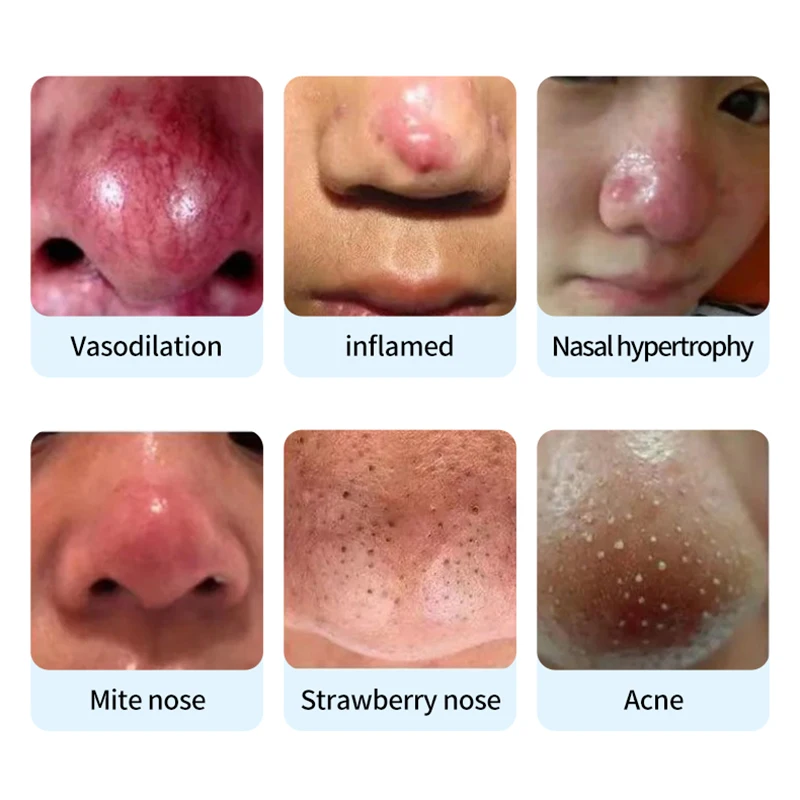 Rosacea-zalf - een actuele gezondheid - Verzorgingspasta voor neusroodheid, vergrote poriën, gebroken capillaires, mee-eters en gerelateerde drosacea-zalf - Een actuele gezondheid - verzorgingspasta voor neusroodheid, vergrote poriën, gebroken