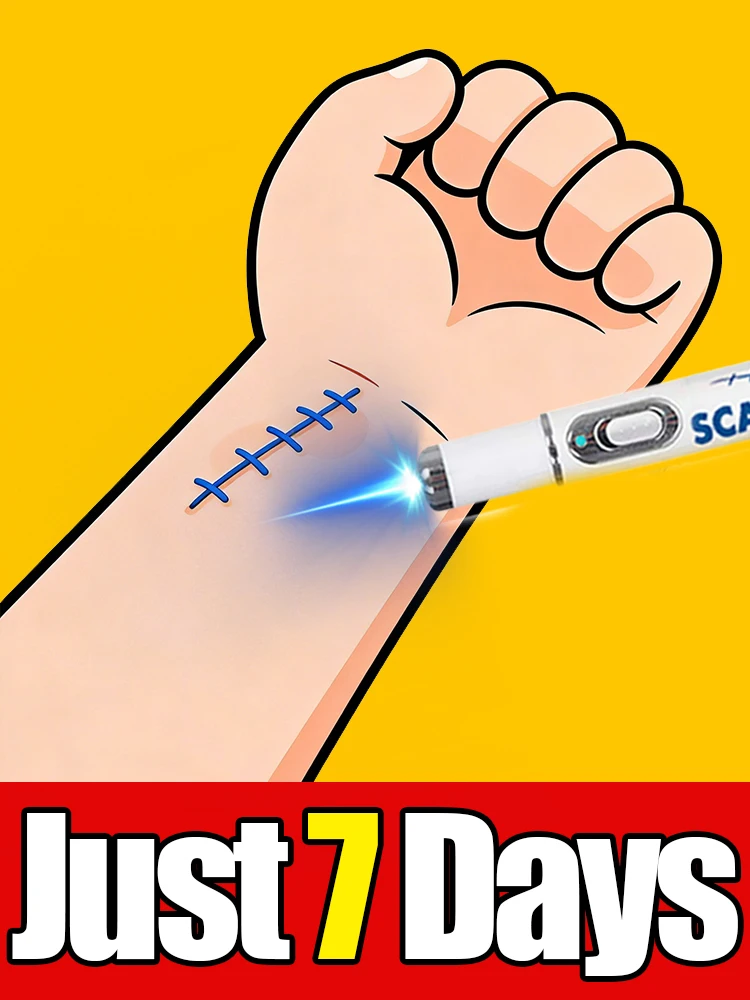 Kostenloser Versand, Blaulichtstift löst Narbe, Narbenpflegewerkzeuge, Unisex. Helfen Sie Menschen mit Narben und lösen ihre Probleme