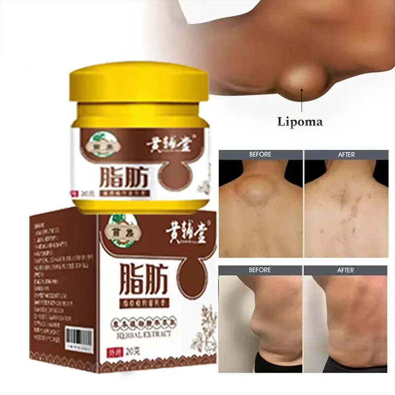 Lipoma Removal Cream Body Cream Dissolving Fat Easy To Use Lipoma Removal Cream