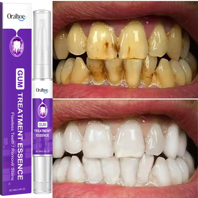 

Purple Teeth Whitening Pen Removes Plaque Stains Cleanses Oral Hygiene Bleach Freshens Breath Takes Teeth Care Korea Products