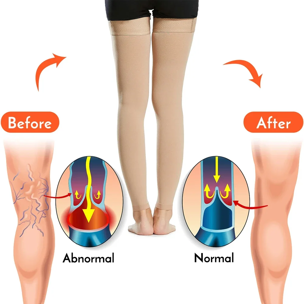 Медицинские компрессионные чулки до бедра с открытым носком и силиконом для женщин и мужчин, градуированная поддержка 20-30 мм рт.ст. для