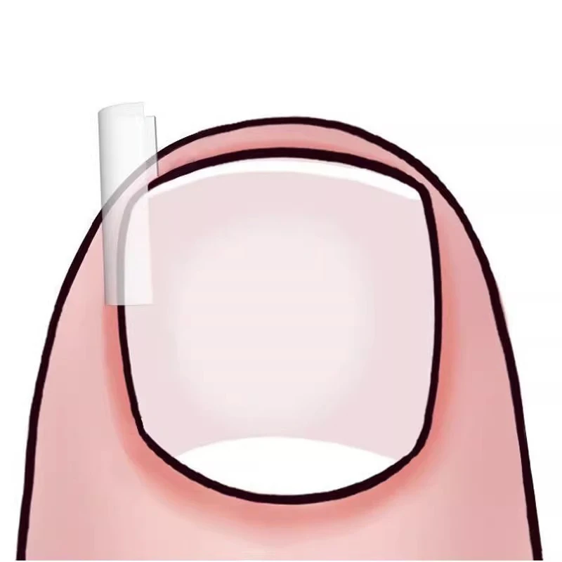 Pince à Redresser les Ongles Incarnés, Outil de Traitement des Ongles, Patch artificiel astique, Autocollant, Soins des Pieds, Pédicure, 50 Pièces