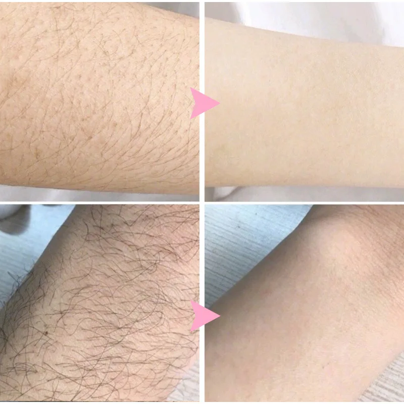 Pulverizador poderoso da remoção do cabelo, removedor permanente indolor do cabelo, inibidor do crescimento, axila, pé, braços, corpo inteiro, creme Depilatório, saúde