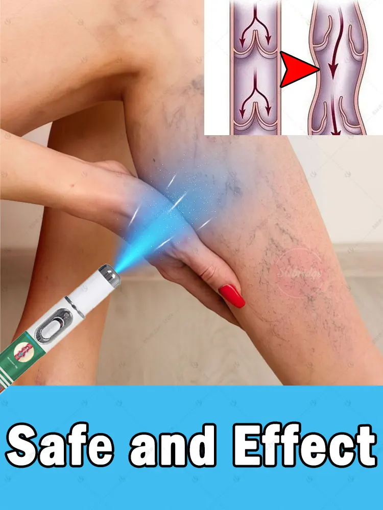 

Эффективно снимает распространенный васкулит в ногах и быстро устраняет варикозное расширение вен.