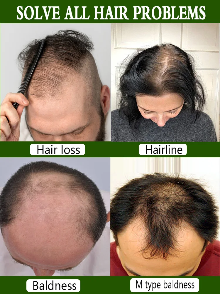 Solve all hair thinning problems