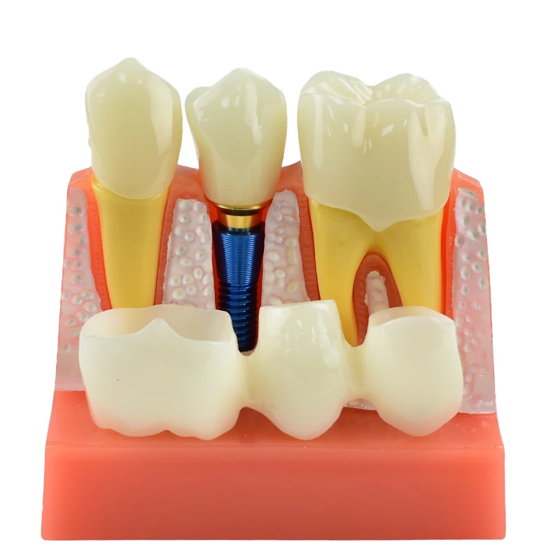 

Dental Teach 4 Times Implant Analysis Crown Bridge Removable Demonstration Teeth Model for Dentistry Lab