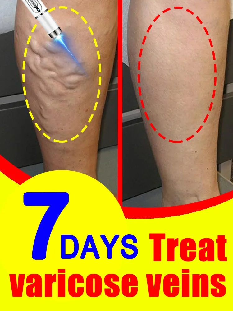 

Quickly remove varicose veins without recurrence