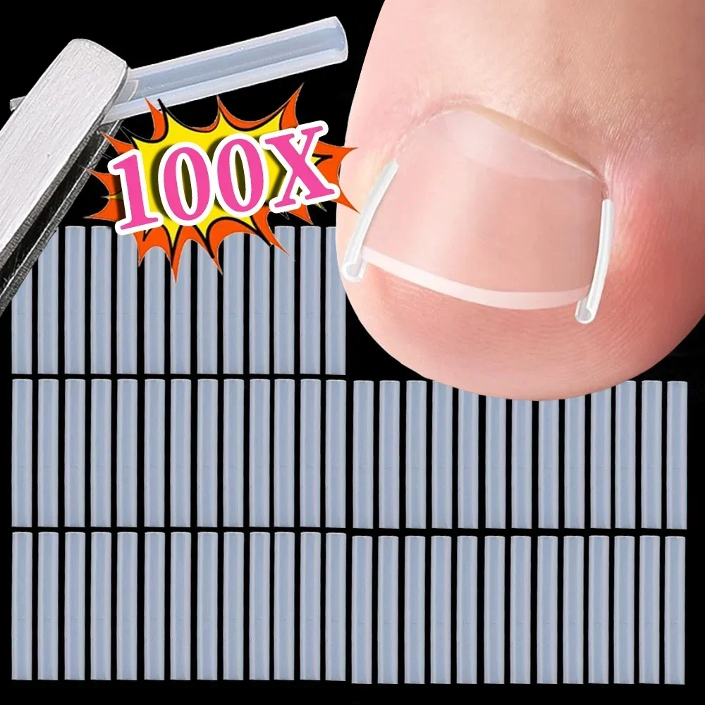 Toenail Straightening Clip Ingrown Toenail Correction Tool Set Nail Treatment Elastic C-shaped Patches Pedicure Foot Care Tools