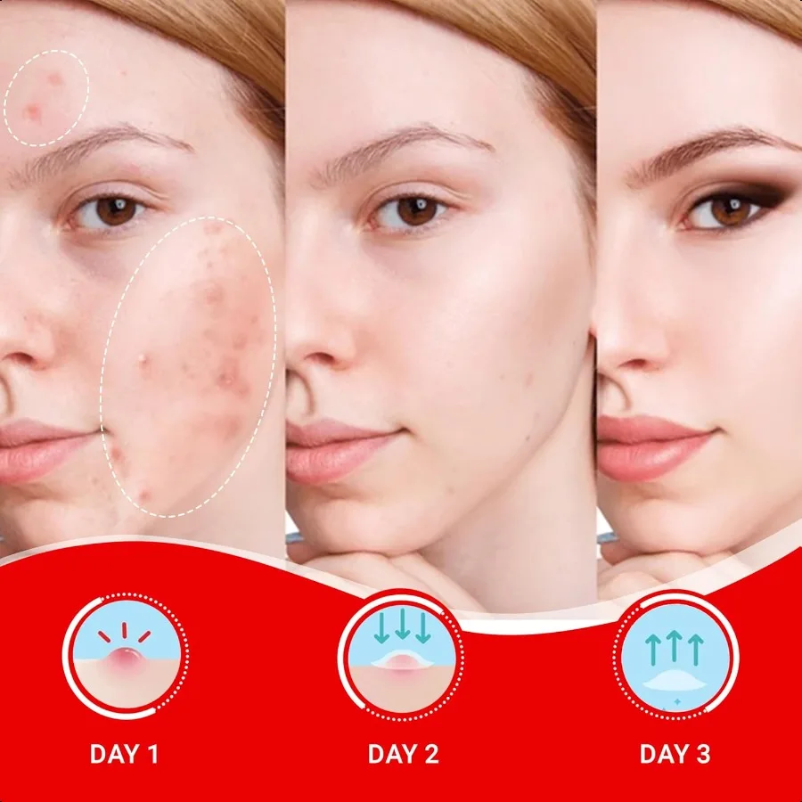 Original Hydrocolloid Acne Pimple Patches for Face 36 Count Invisible Spot Stickers with Salicylic Acid Tea Tree Oil for Zits B