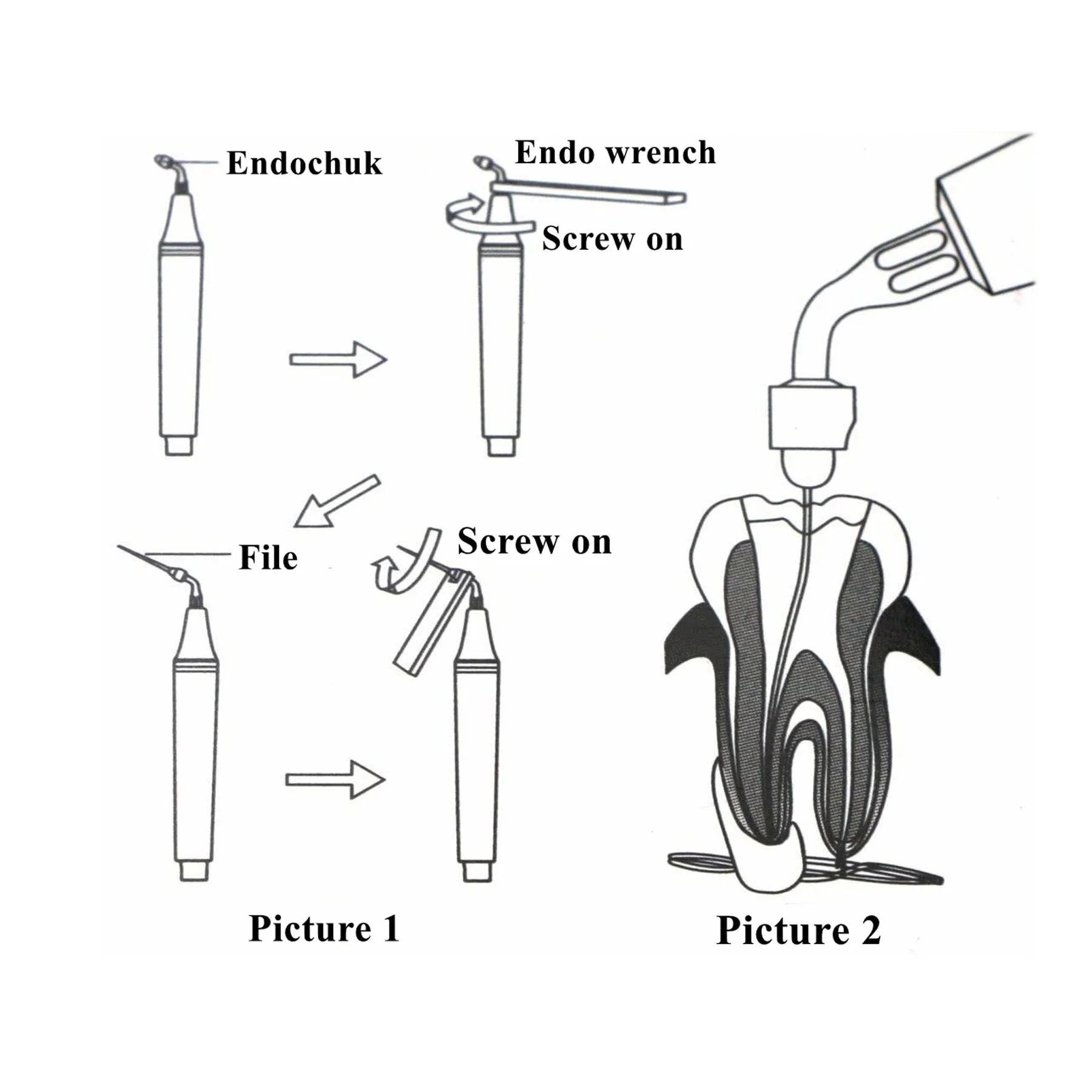 Woodpecker DTE Dental Ultrasonic Perio Scaler Tip Root Canal U-file Fit SACTEON ATELEC NSK Scaler Tips Endo Wrench