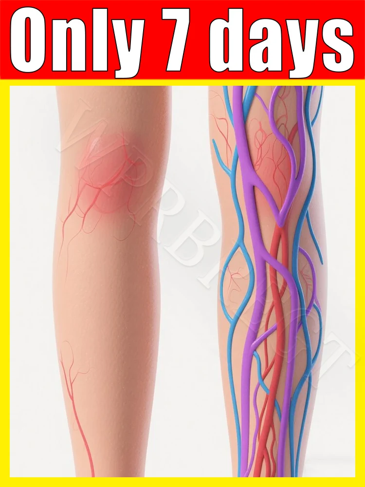 

Pᴀɪɴʟᴇss ᴛʀᴇᴀᴛᴍᴇɴᴛ of spider veins and abnormal leg bleeding, varicose vein laser treatment, laser pointer