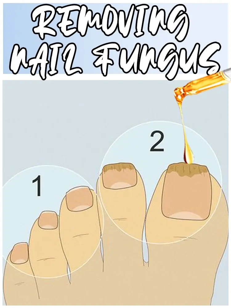 Verabschieden Sie sich von Onychomykose, keine Wiederholung, keine Schäden an Nägeln.