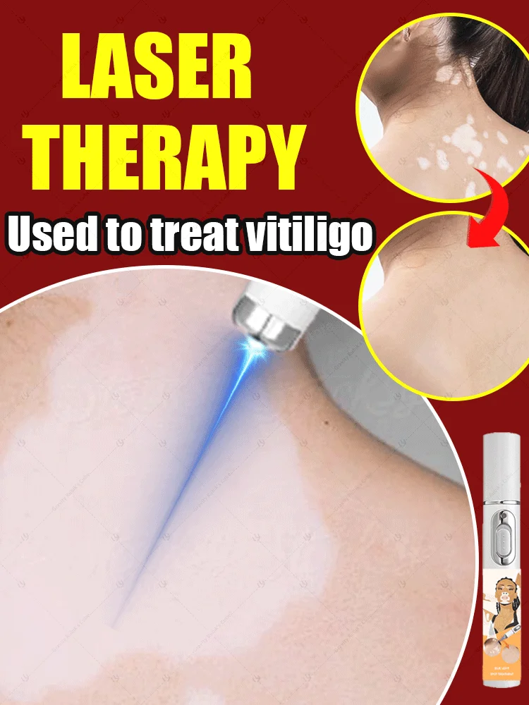 

blue laser improves vitiligo，2025 hot selling Nursing tools