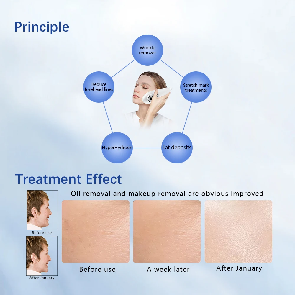 Naaldloze Dermo-elektroporatie (DEP) Infusie Dep Ultrageleide niet-invasieve huidverstrakking Ionenintroductie Trillingen