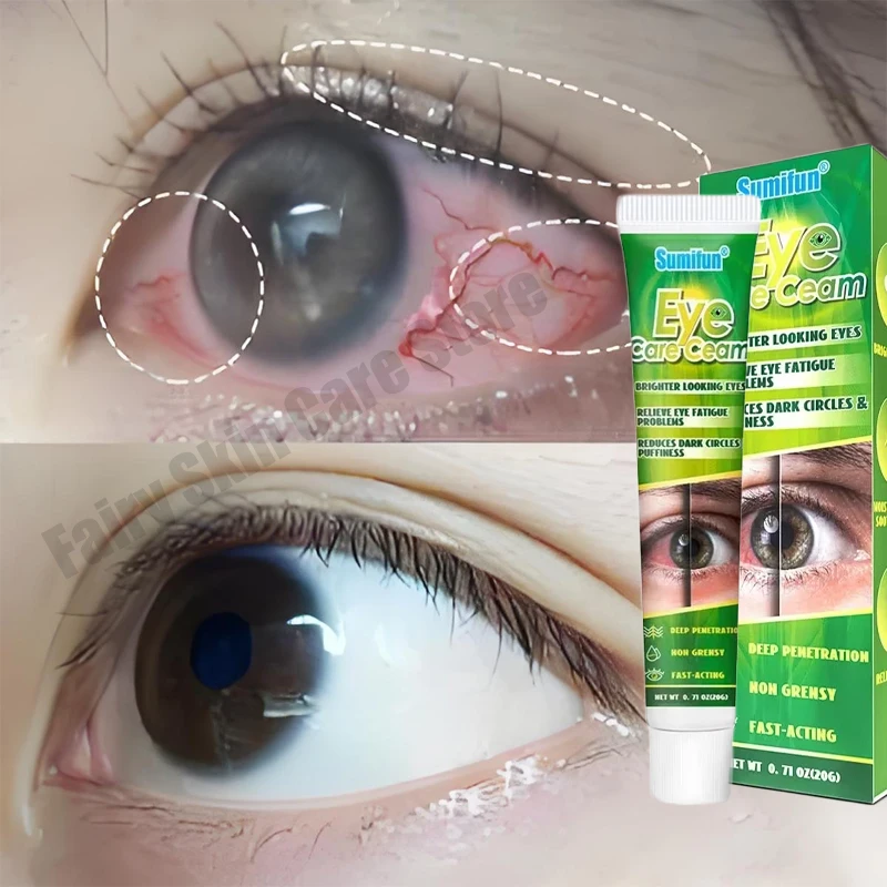 

Chinese Herbal Medicine Eye Care Cream Brighter Looking Eyes Relieve Eye Fatigue Problems Reduces Dark Circles And Puffiness