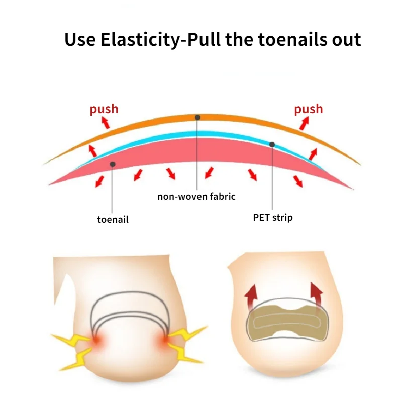 20/50/100pcs Nail Correction Stickers Ingrown Toenail Corrector Patches Paronychia Treatment Recover Corrector Pedicure Tools