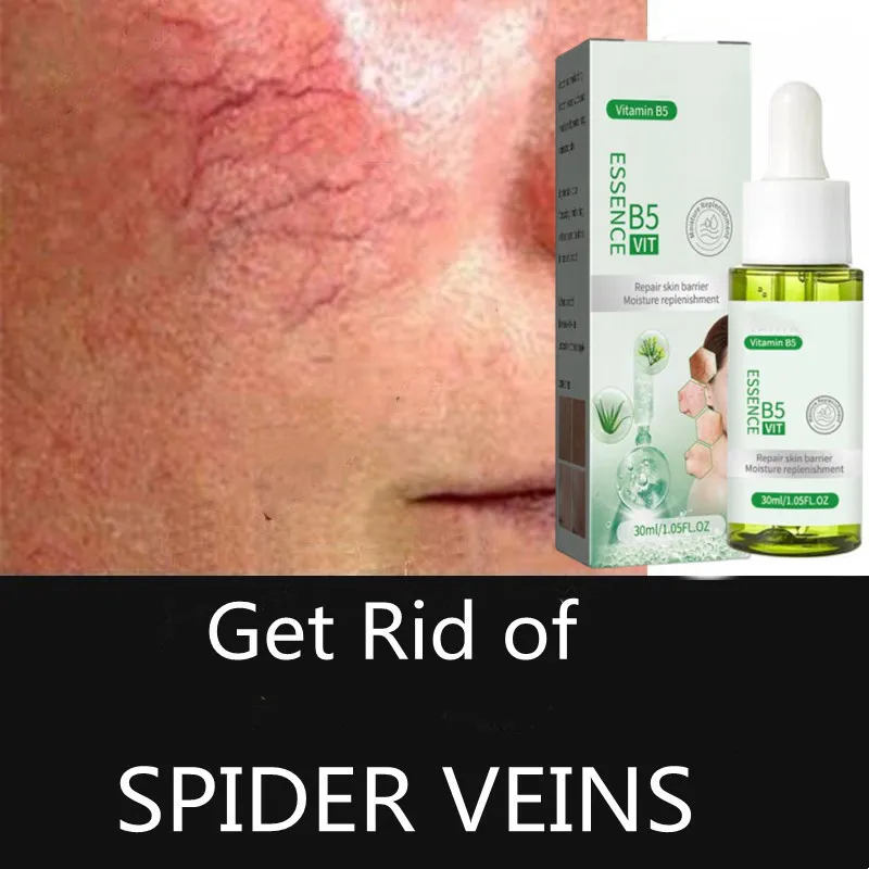 30ML Anti Redness Soluation ,Spider Vein Removal Advanced treatment Clearer skin Veins on Face