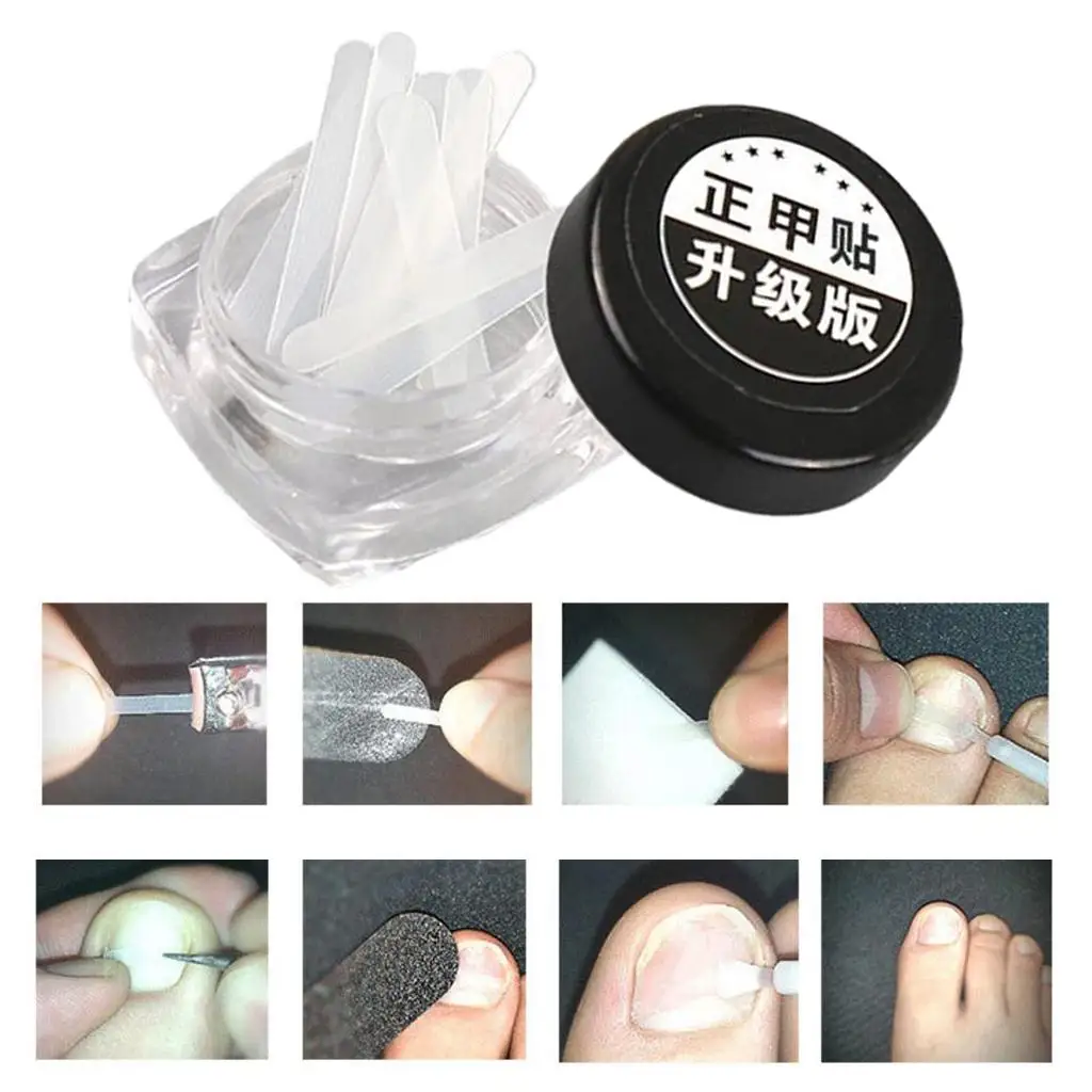 Autocollants pour traitement des ongles incarnés, patch élastique, outils de pédicure, 10 pièces