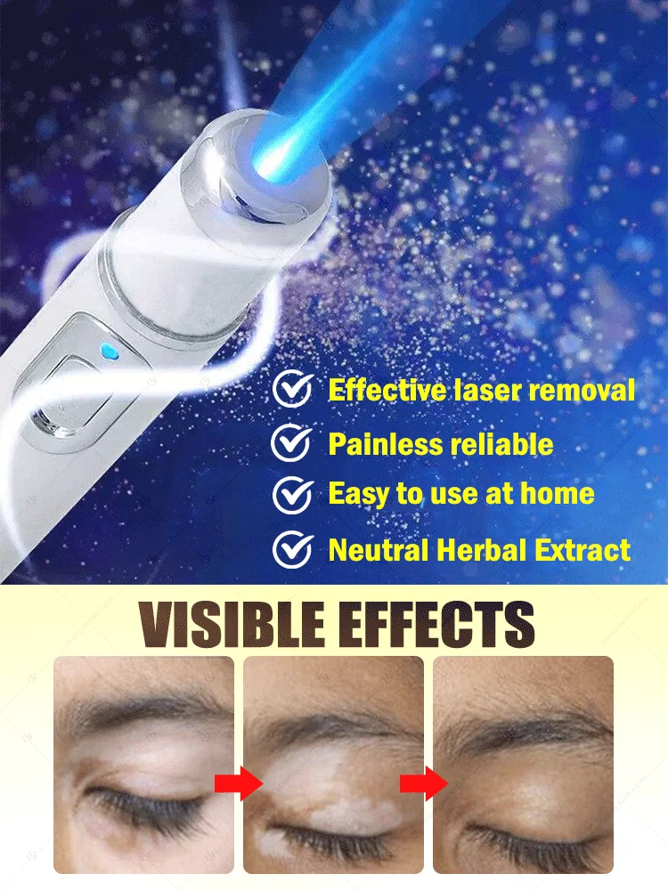 Pena cahaya biru mengatasi Vitiligo, Pena Perawatan Tubuh Terapi Laser