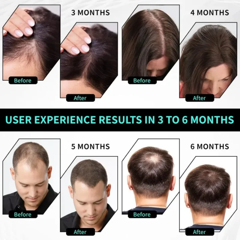

Professional Hair Growth Device - Stimulates Follicles & Reduces Scalp Oil for Thicker Hair