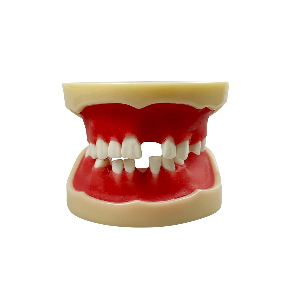 نموذج زراعة الأسنان المفقودة للأسنان أبحاث الأسنان نموذج للتدريس تدريب طلاب الأسنان وضع التدريس #6