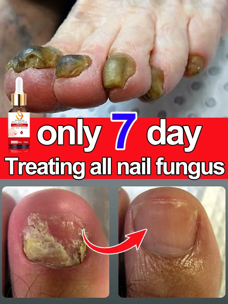 The most powerful black technology in 2024 will completely solve the problem of nail mold!