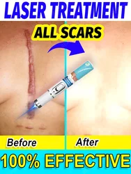 SCAR LASER