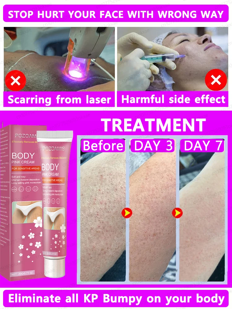 Krim Keratosis Pilaris Losion Tubuh penghilang kaki stroberi penghilang jerawat kulit