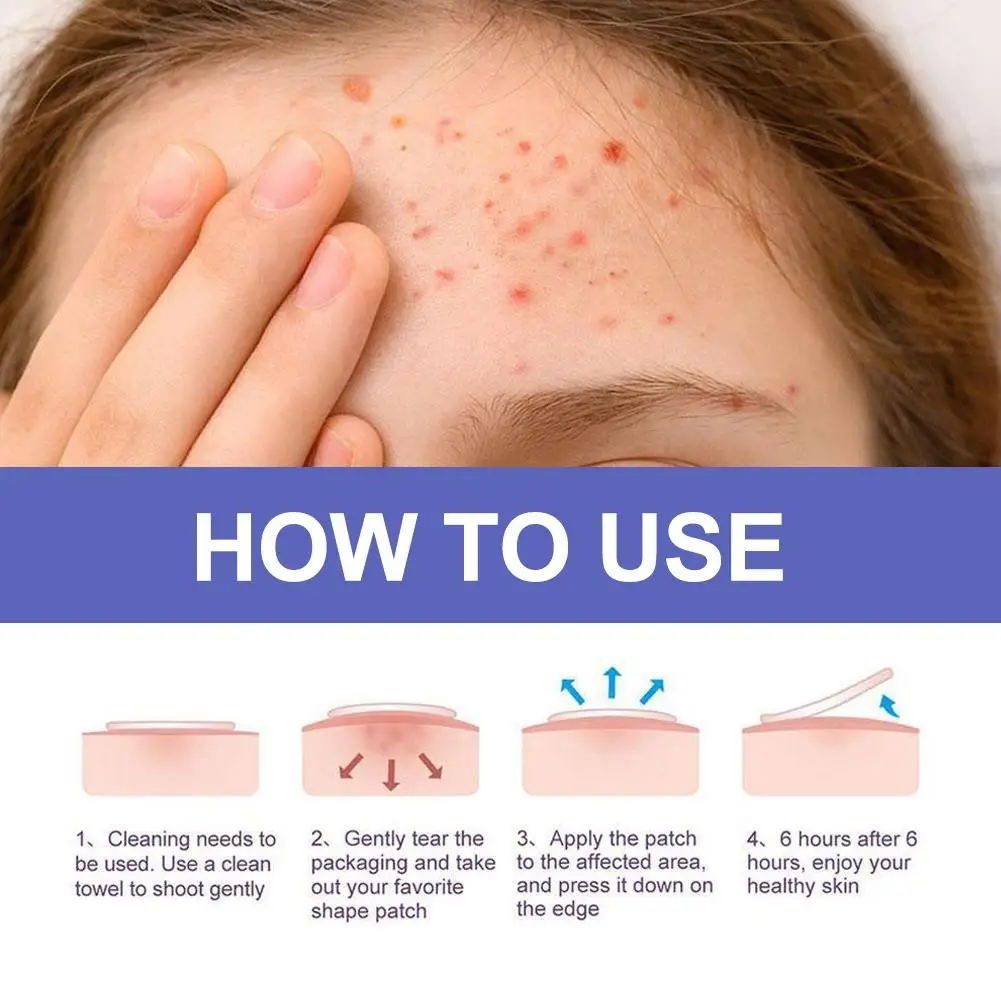 Patch impermeável do acne do diamante do laser, pontos de mancha da espinha, tratamento não-irritante, cuidados faciais, beleza da pele respirável, P3Q4