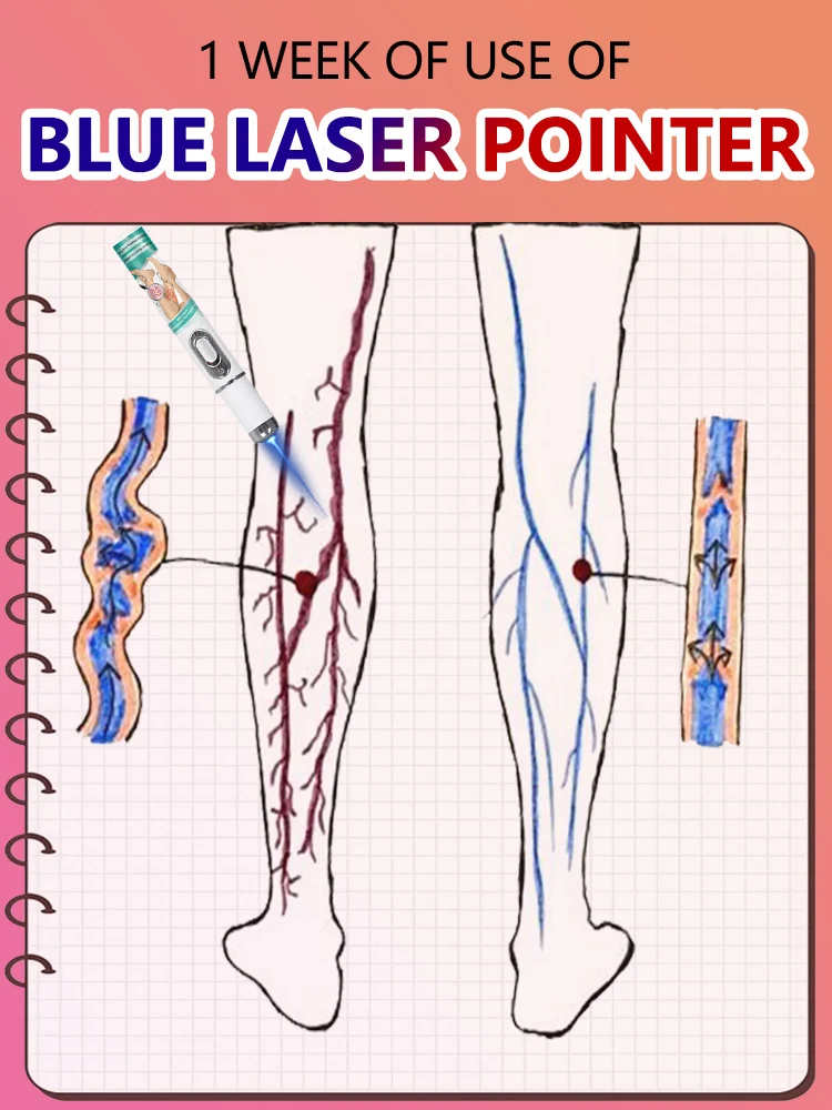 

New Vein blue light tool, Leg care tools solve varicose veins