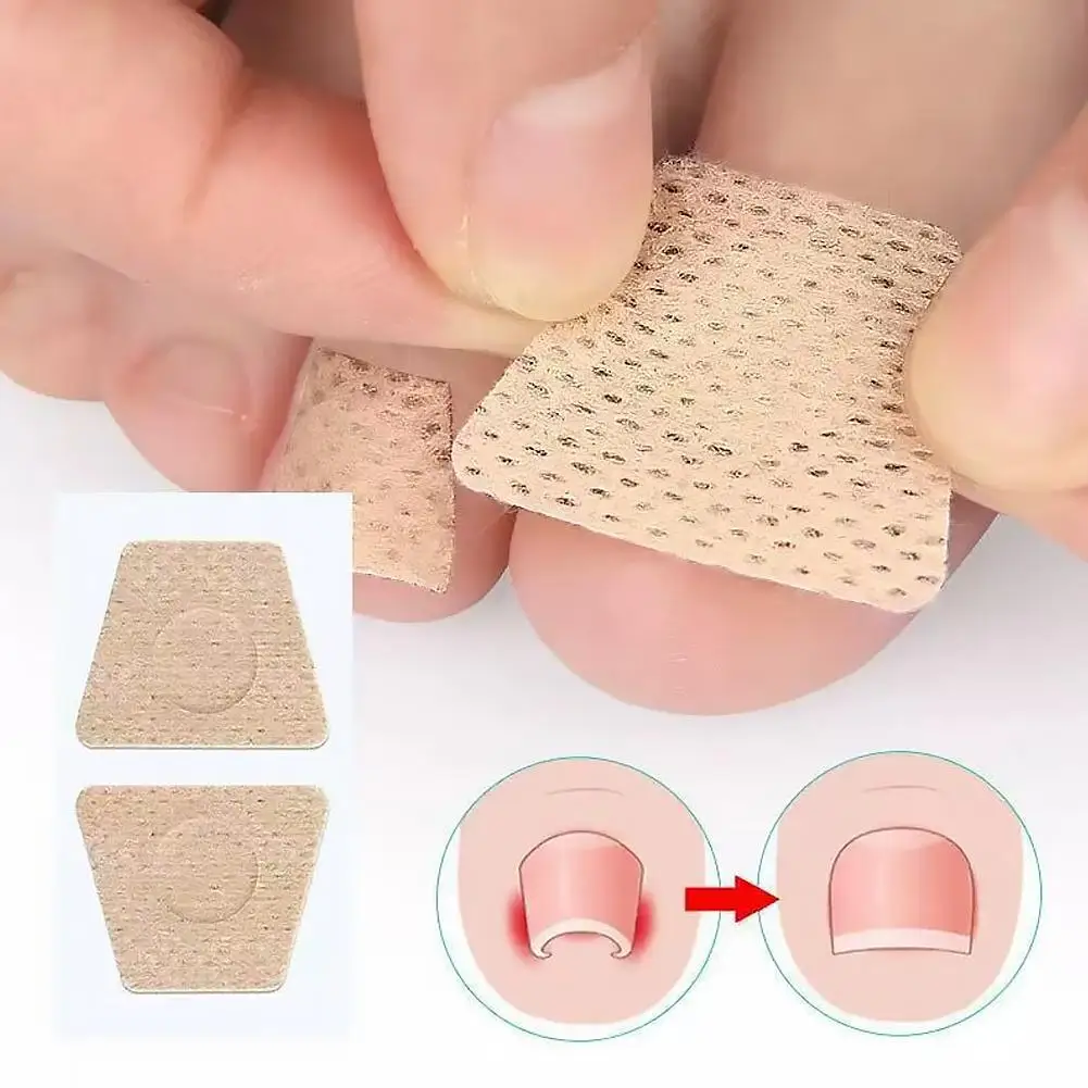 2/10/20/40PCS Toenail Repair Patch For Fungus Ingrown Nails Correction Stickers For Discolored Damaged Nail Foot Care