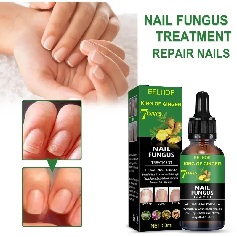 Efficient Nail Repair Solution Treating Cracked Discolored Nails Gray Foot Care Toe Nail Sterilization Gel Nourishing Essence