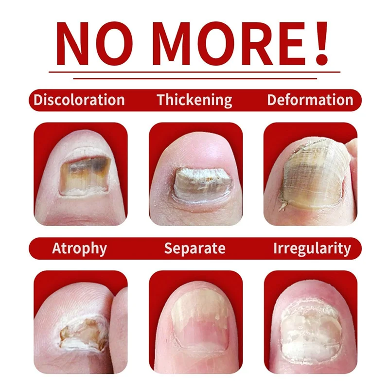 العناية بالأظافر بالزنجبيل، إصلاح الأظافر متعدد الأغراض، زيت مغذي للأظافر، زيت تقوية، زيت نمو أظافر الزنجبيل