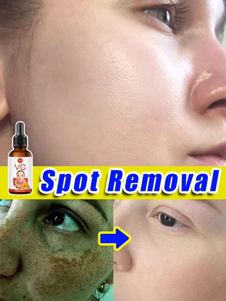 

Facial skin Care Freckles Dark Spot Removal