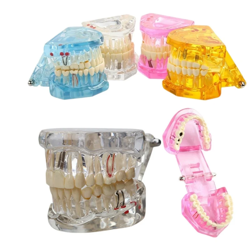 Dental Teeth Model Implant Disease  Dentist Study Model With Restoration Bridge Tooth Demonstration Models For Patient Education