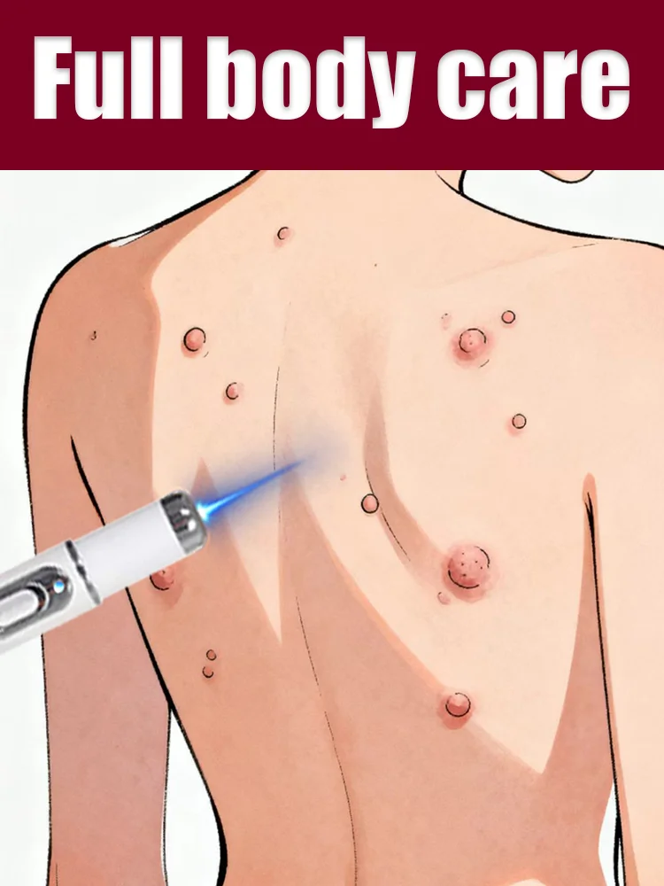 

Say goodbye to all warts in 7 days with this cleansing and soothing blue light pen.