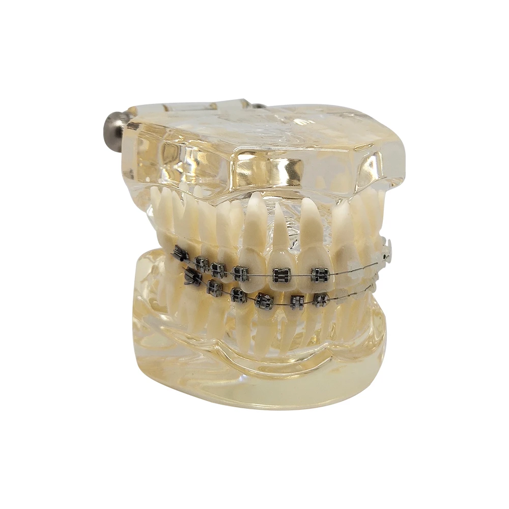 Dental Orthodontic Teeth Model With Ceramic And Metal Brackets Upper And Lower For Dentistry Demonstration Patient Communication