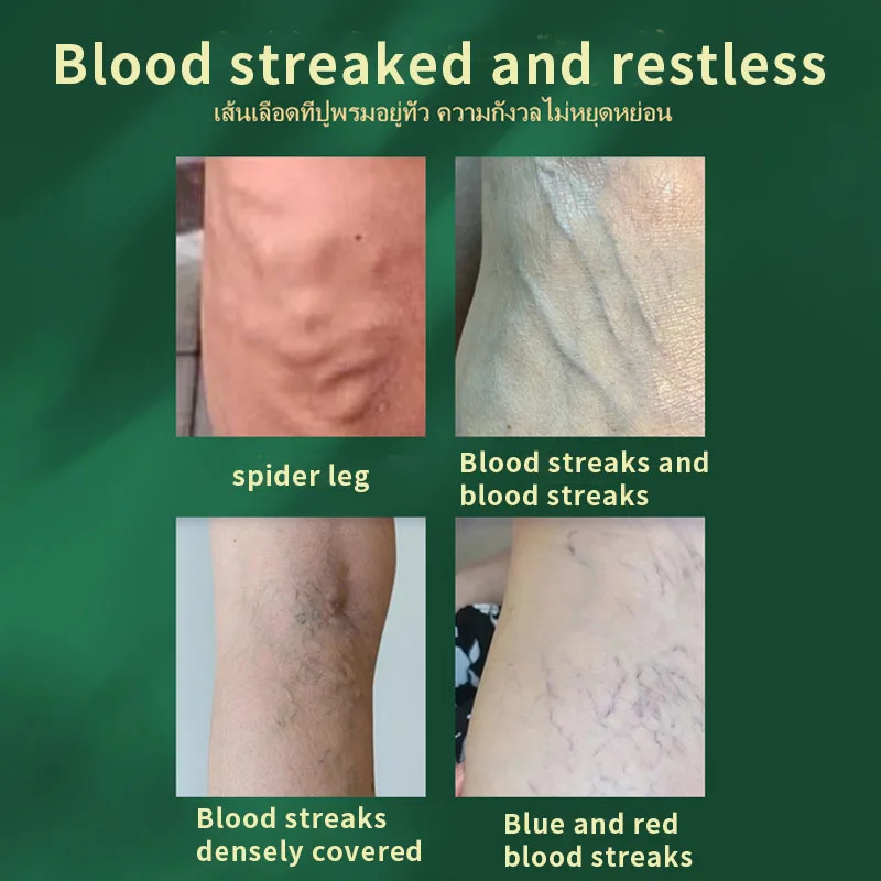 Thai Vein-Relaxing Health Care Ointment to Relieve Discomfort Caused by Blood Vessel Dilation, Soreness, Numbness, and Swelling, External Care Application Ointment view 2
