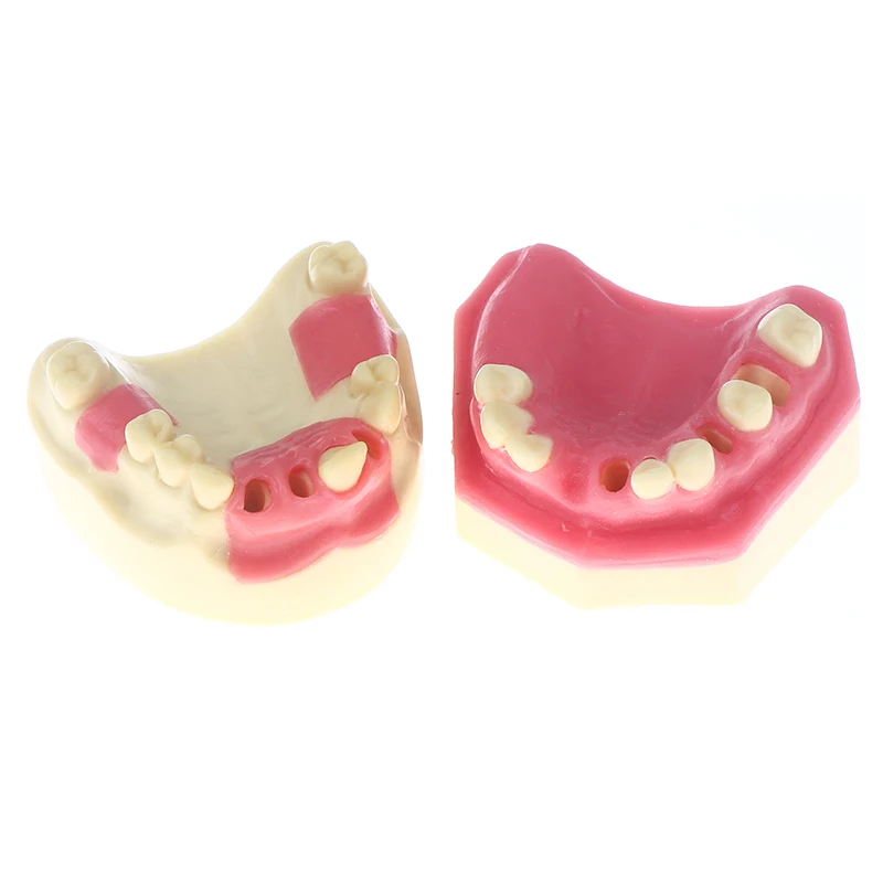 نموذج فقدان الأسنان زرع الأسنان طالب التدريب التدريب المعونة ممارسة نموذج العلوي الفك رفع يزرع استعادة نموذج مختبر