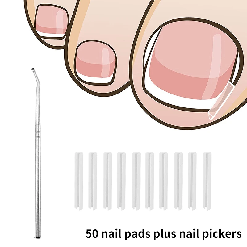 50Pcs Ingrown Toenail Correction Tool Ingrown Toe Nail Treatment Elastic Patch Sticker Straightening Clip Brace Pedicure Toos