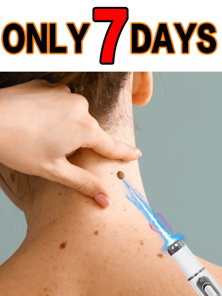 

Синий лазерный указатель 2026, абсолютно новый, для удаления бородавок, корней, быстро, обновленная версия, без забот