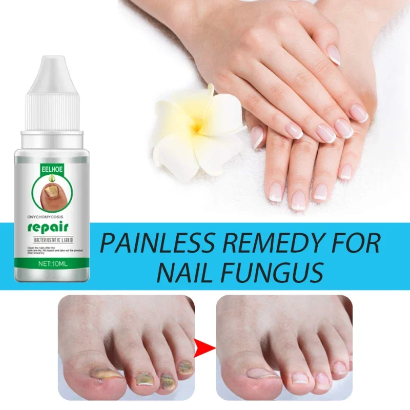 Nail Fungus Treatment Serum Repair Fungus Removal Essence Liquid Onychomycosis Foot Care Gel Anti Infection Thicken Soft Nails