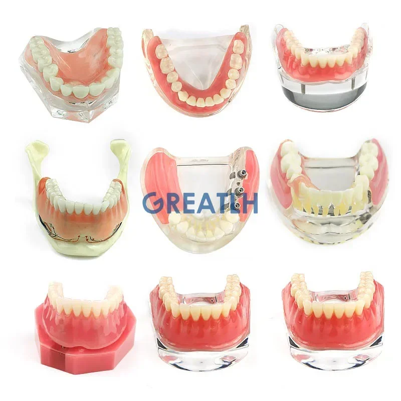 Denti per sovraprotesi dentale modello interno rimovibile mandibolare denti inferiori modello mandibolare con impianto per studio didattico dei denti